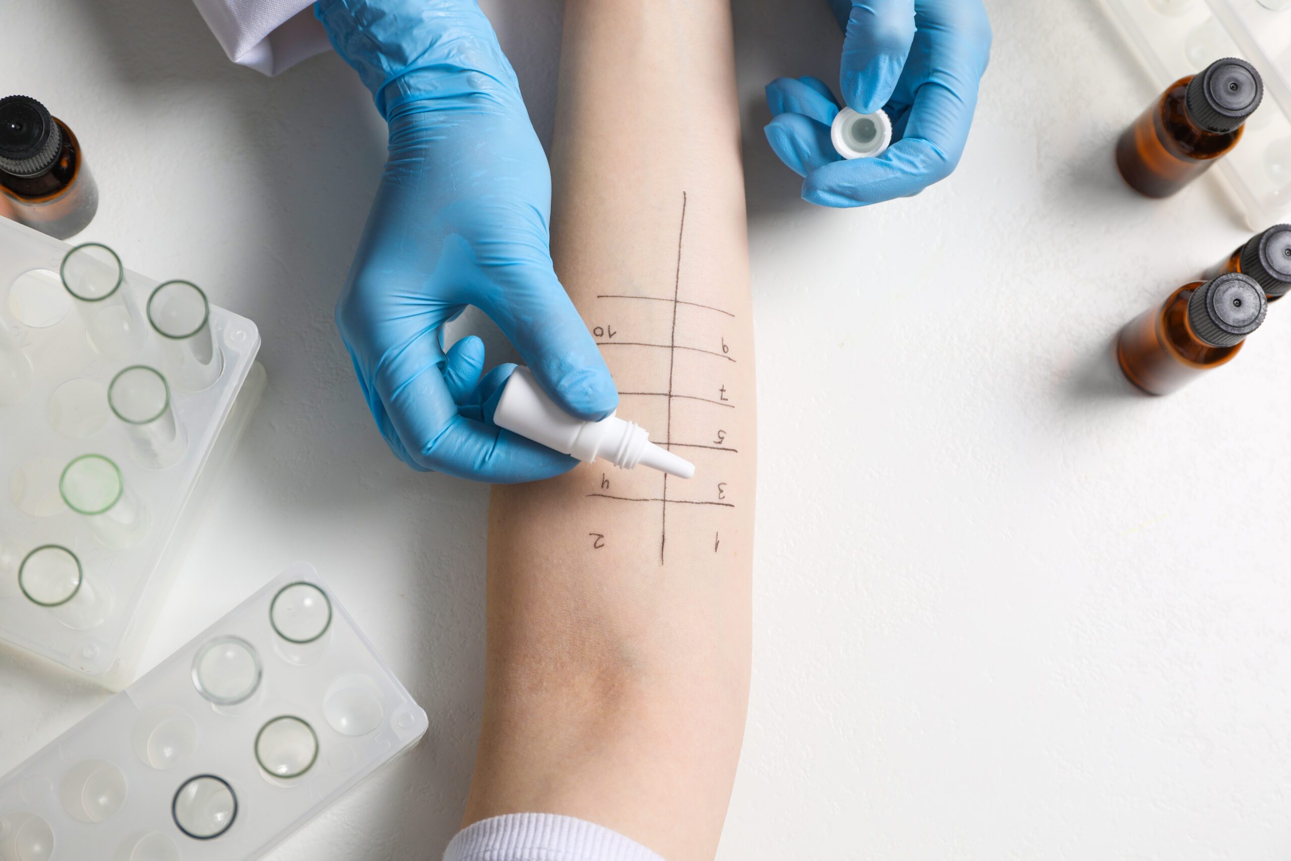 dermatology allergy test on forearm